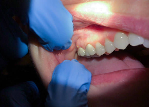Best Emergency Dental Care for Broken or Chipped Teeth in Helena Valley West Central, MT