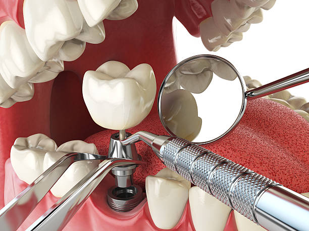 Best Emergency Denture Repair in Helena Valley West Central, MT